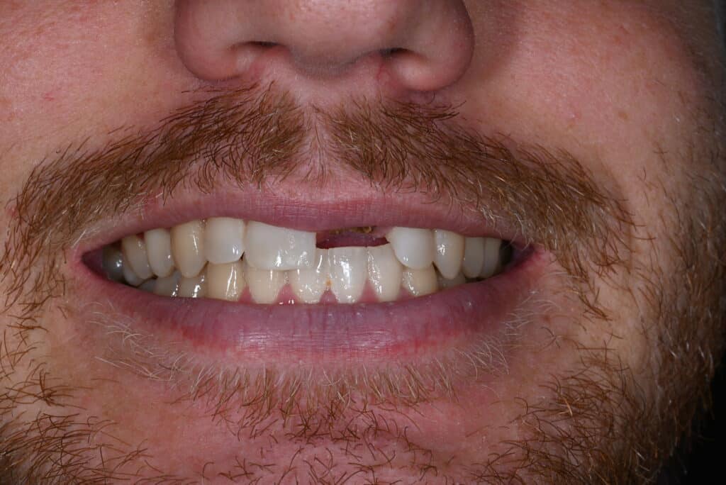 Before
