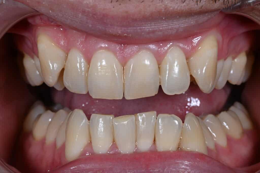 Before