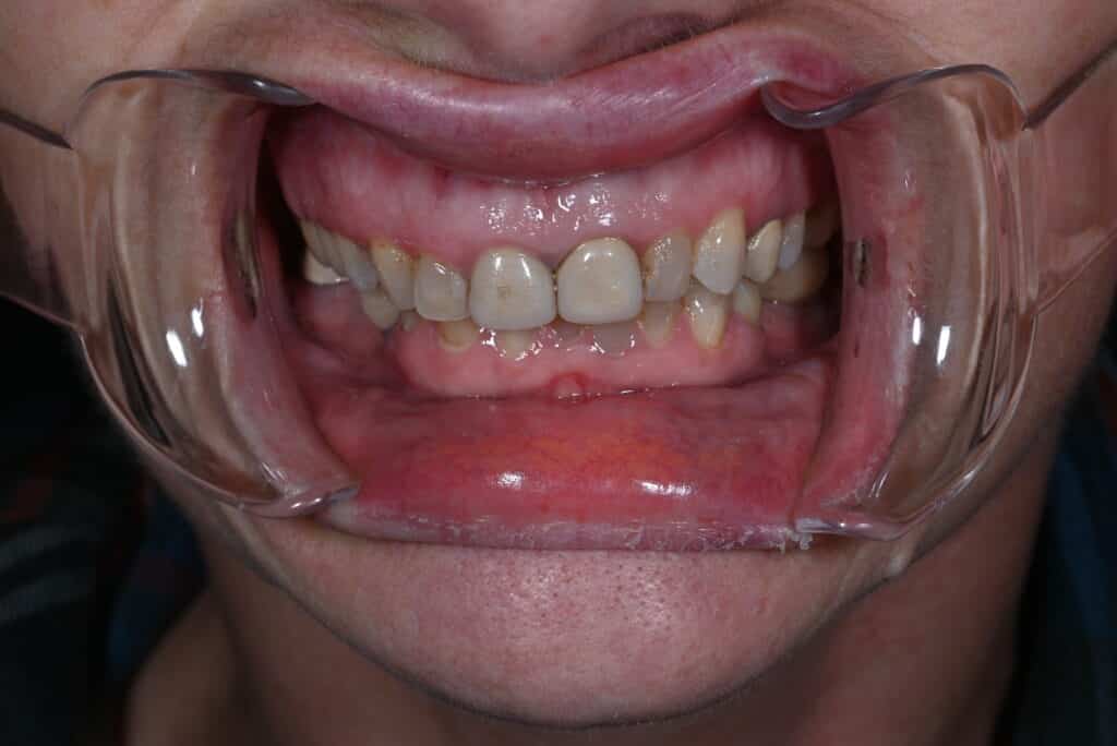 Before